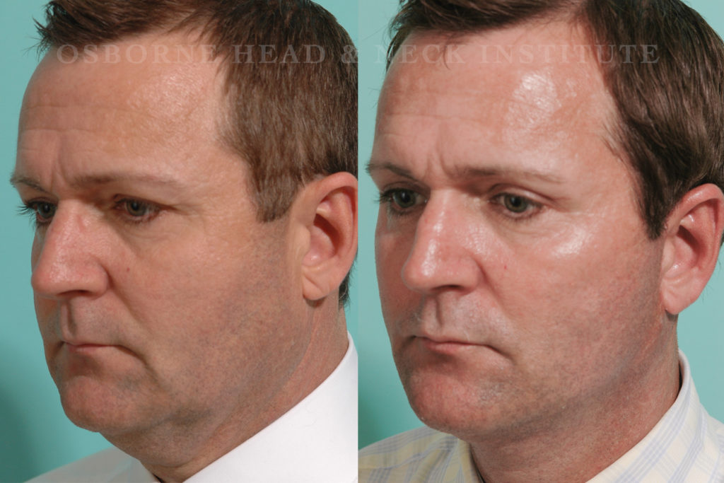 male facelift los angeles